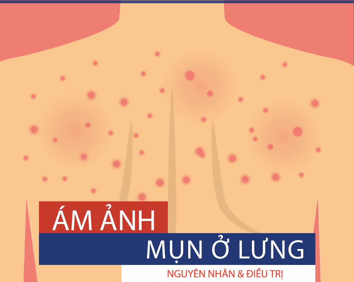 Các nguyên nhân gây mụn ở lưng và cách điều trị dứt điểm nhanh chóng